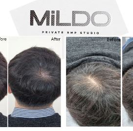 동래두피문신전문 MiLDO_SMP 두피진단