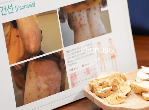 생기한의원이 설명하는 건선 진료 전 증상 경과 정리 방법